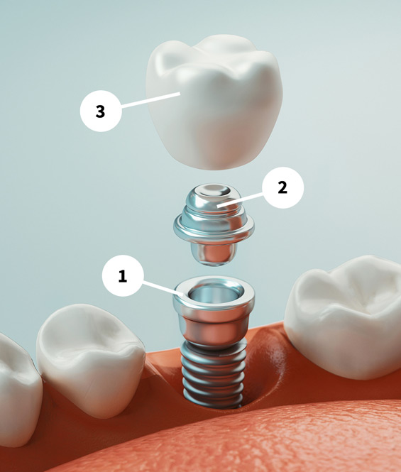 Diagram of implant with restoration